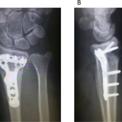 Describes the surgical suturing or wiring together of bones