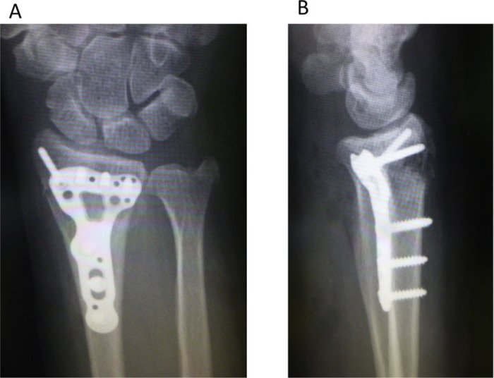 Describes the surgical suturing or wiring together of bones